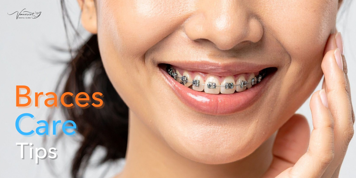 Braces Care Tips