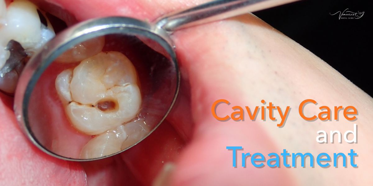 HOME - English 30 Cavity Care and Treatment
