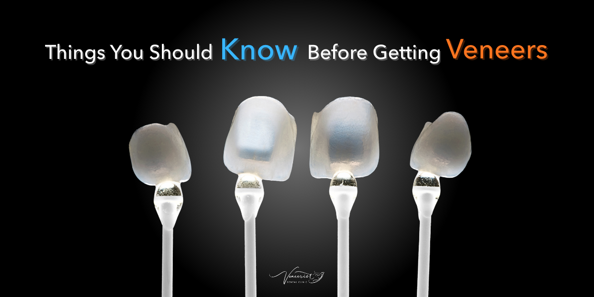 Things You Should Know Before Getting Veneers