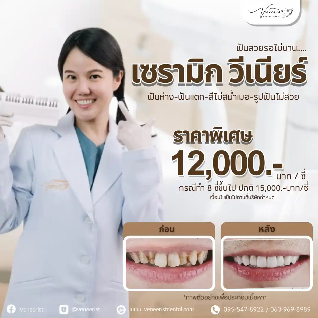 โปรเซรามิก วีเนียร์