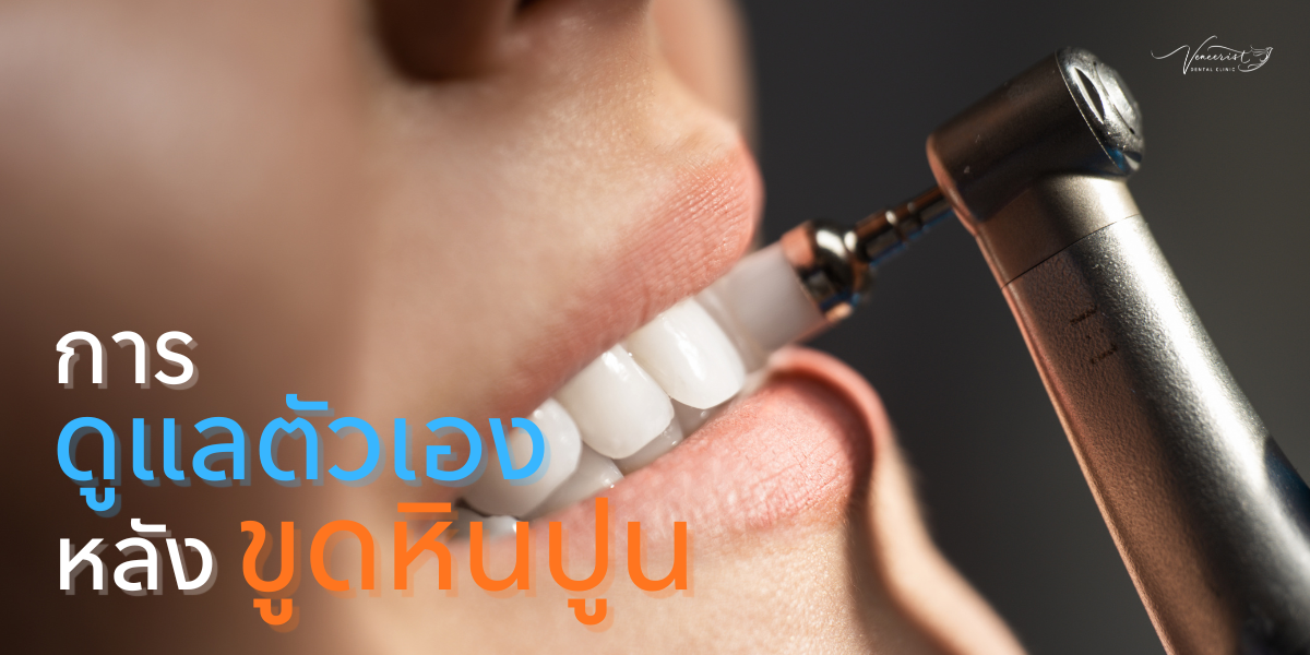 การดูแลตัวเองหลังขูดหินปูน