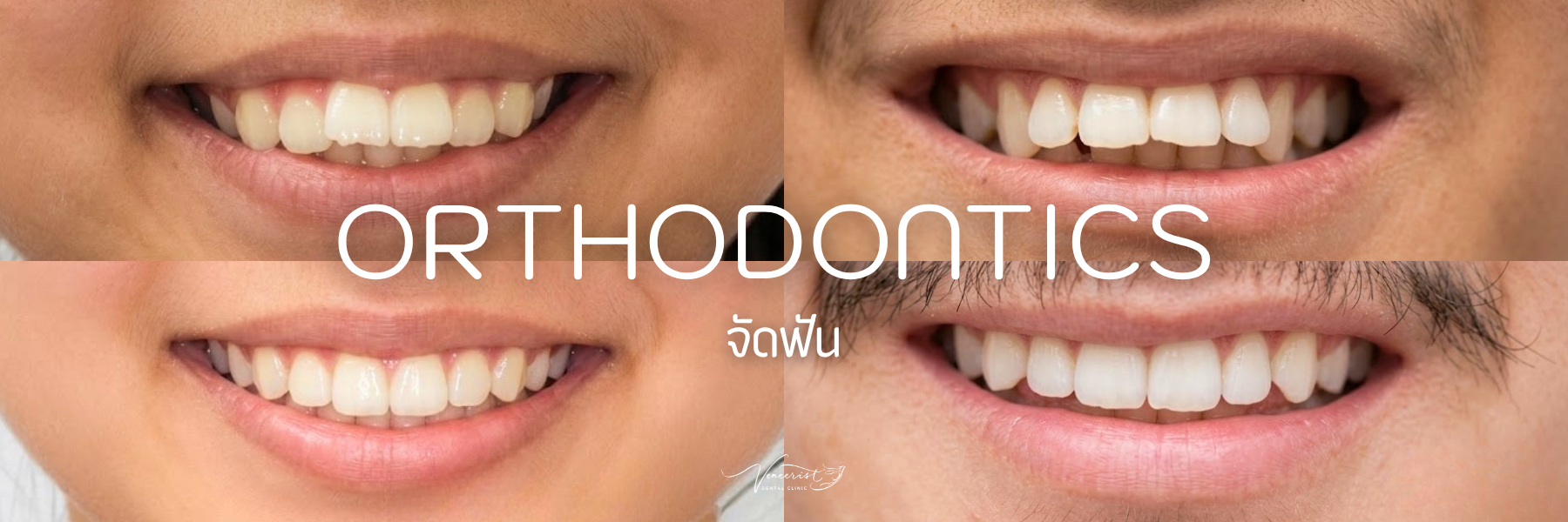 จัดฟัน
