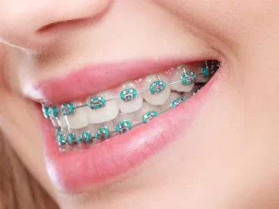 จัดฟันโลหะ (Metal Braces)