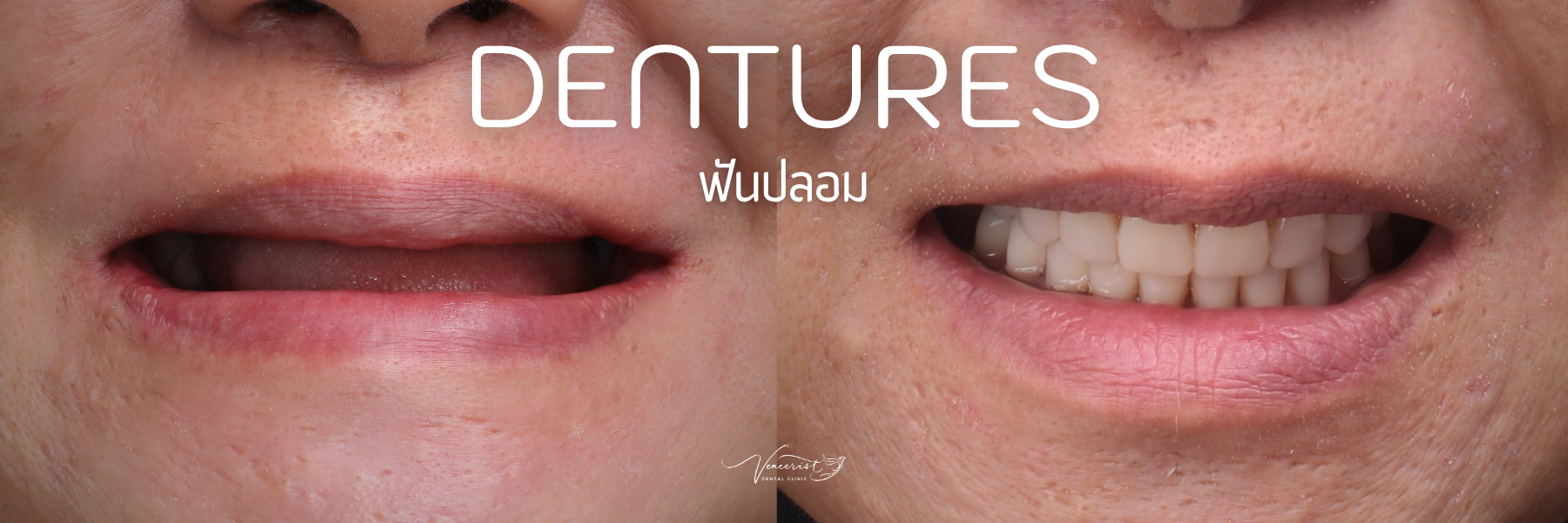 ฟันปลอม denture