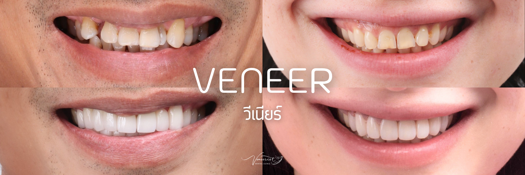 วีเนียร์
