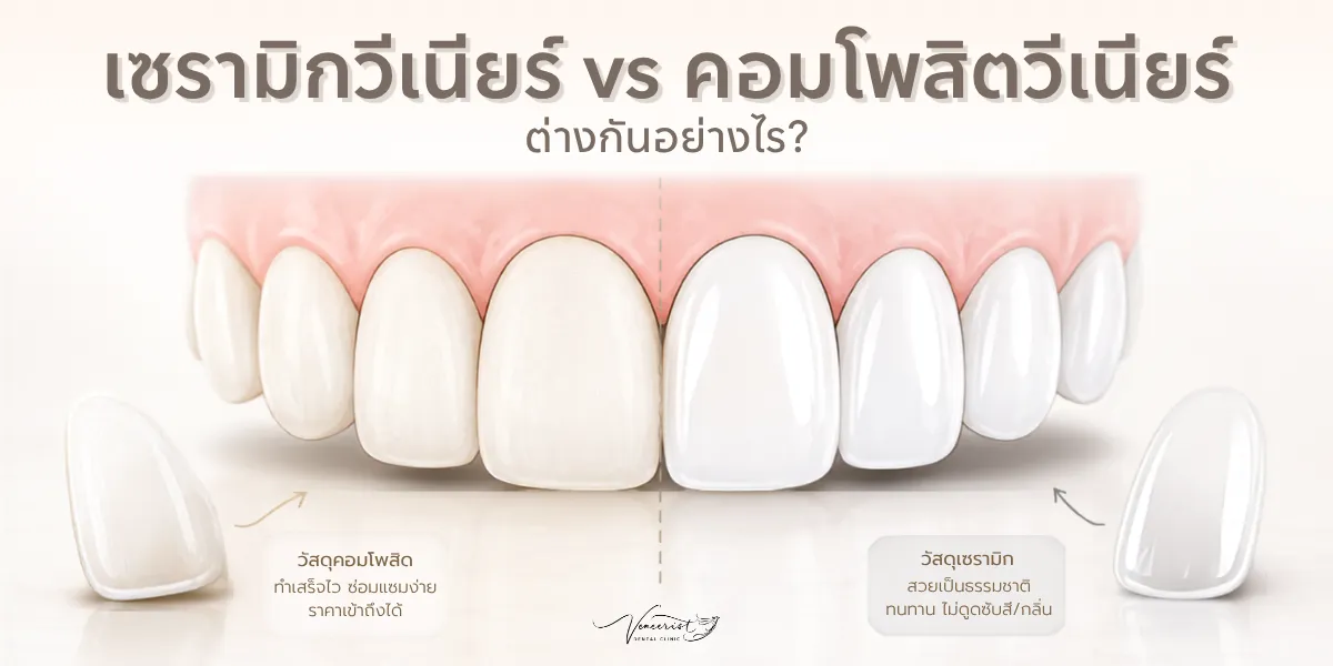 HOME 31 เซรามิกวีเนียร์ vs คอมโพสิตวีเนียร์ ต่างกันอย่างไร เลือกแบบไหนดีให้เหมาะกับรอยยิ้ม