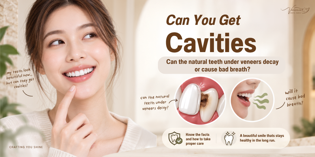 Can natural teeth develop decay under Ceramic Veneers
