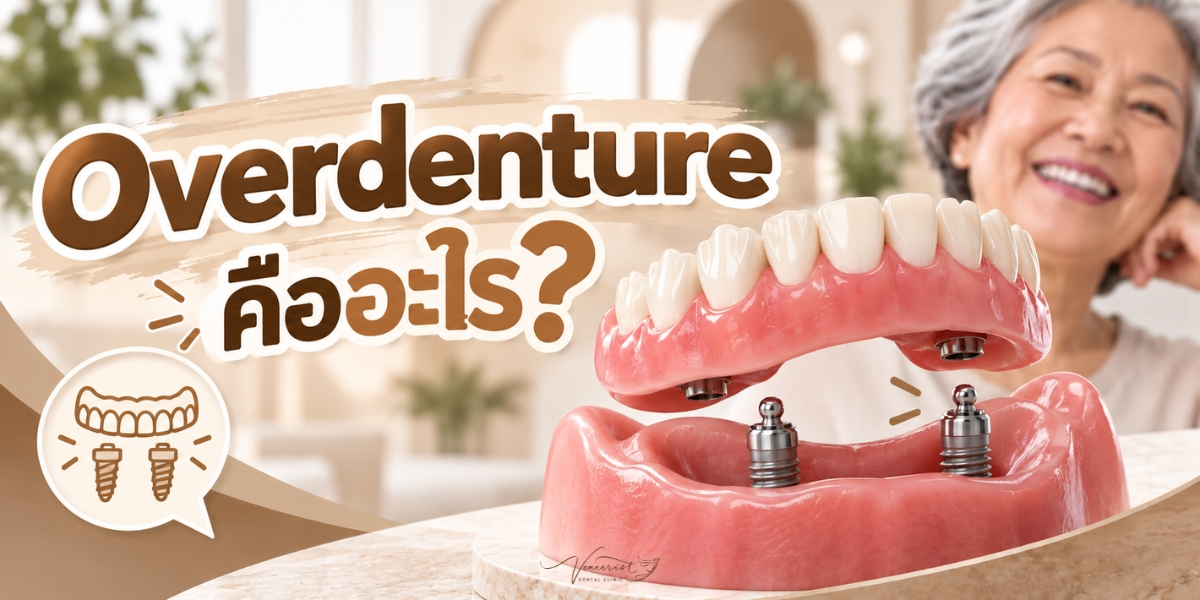 Overdenture คืออะไร ฟันปลอมถอดได้ที่มีรากฟันเทียมช่วยยึด