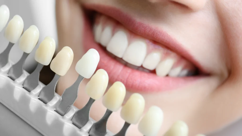 How Long Do Veneers Take? How Many Dental Visits Are Needed? 2 Veneer Shades