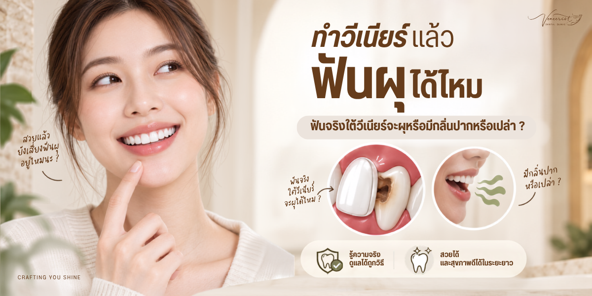 ฟันจริงใต้ Ceramic Veneers สามารถเกิดฟันผุได้หรือไม่