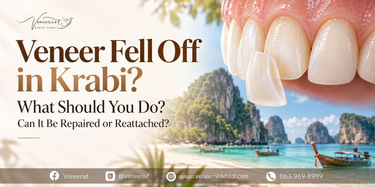 Veneer fell off in Krabi, ceramic and composite veneer repair assessment