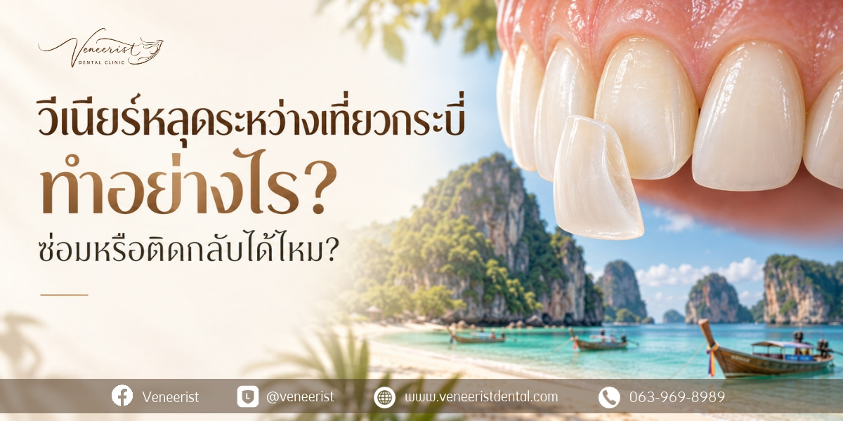 วีเนียร์หลุดระหว่างเที่ยวกระบี่ การตรวจประเมินเซรามิกวีเนียร์และคอมโพสิตวีเนียร์ที่หลุดหรือแตก